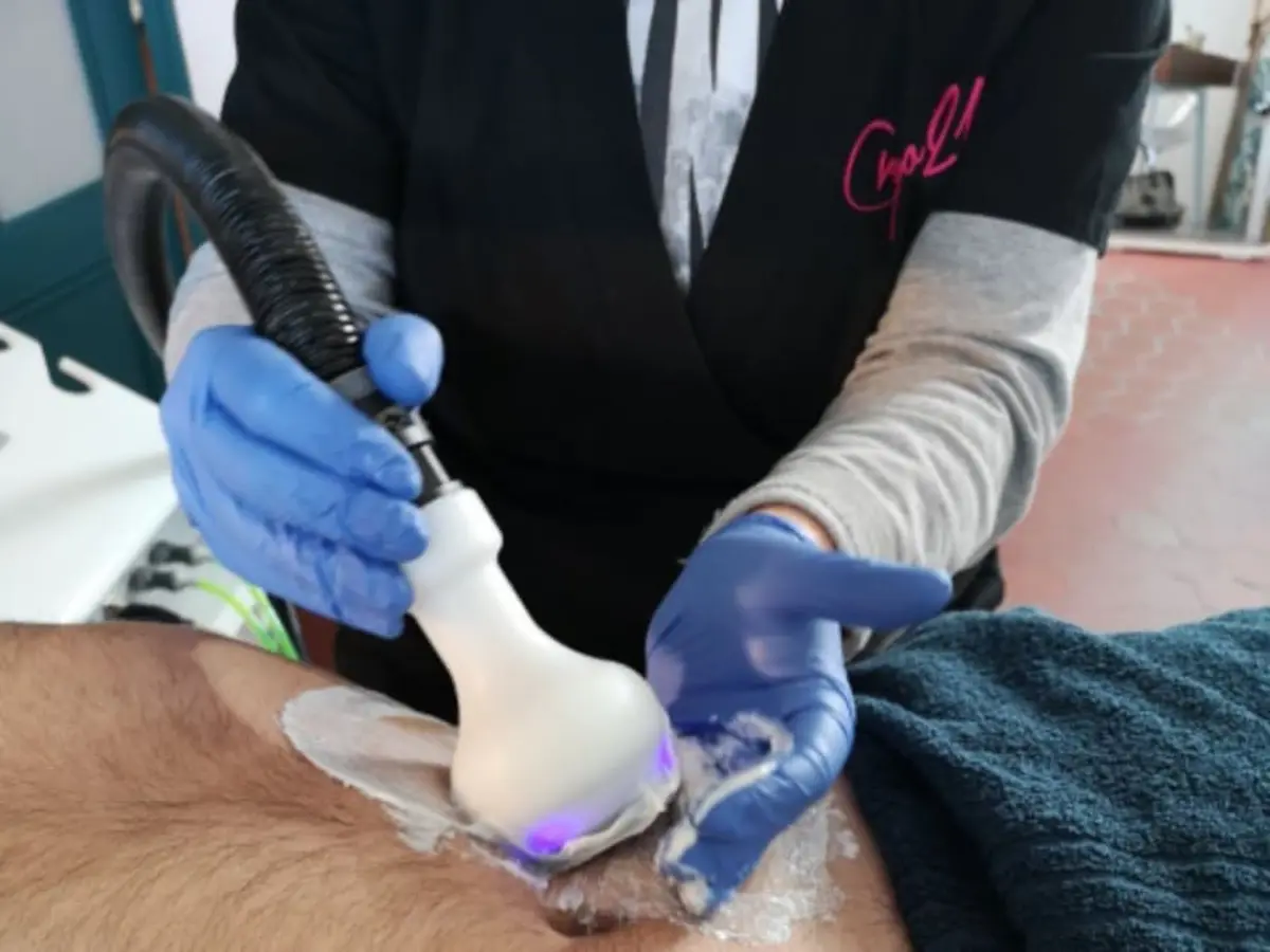 Cryolipolyse à Marseille (13)