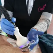 Cryolipolyse à Marseille (13)