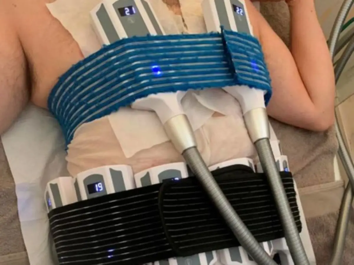 Cryolipolyse à Saint-Germain-sur-Morin (77)