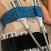 Cryolipolyse à Saint-Germain-sur-Morin (77)