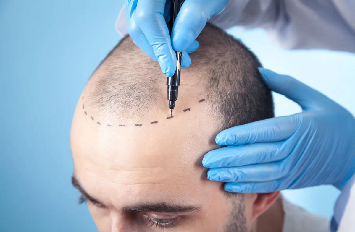 Greffe de cheveux en Turquie : l’expertise d’Istanbul