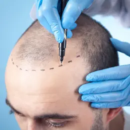 Greffe de cheveux en Turquie : l’expertise d’Istanbul
