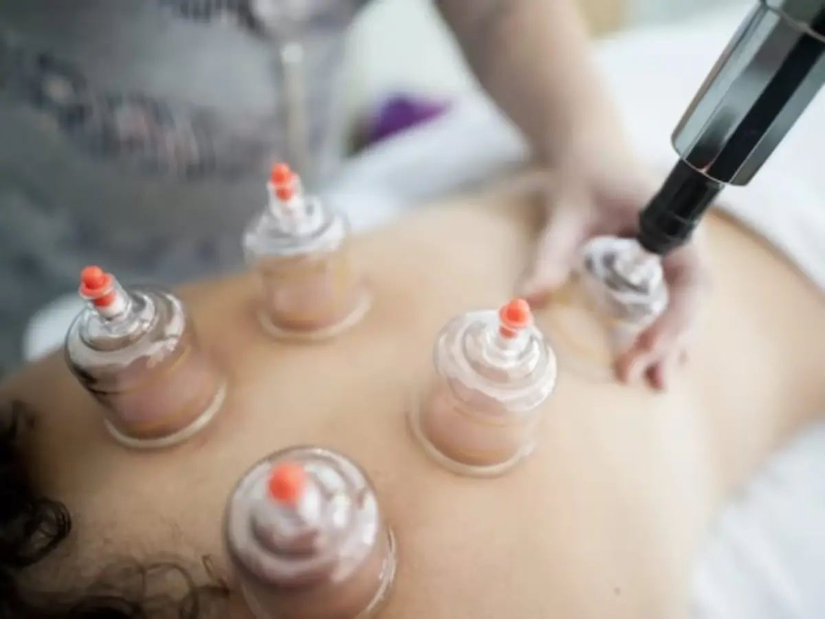 Séance de Cupping Therapy à Lyon